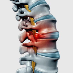 Điều trị bệnh viêm đa khớp