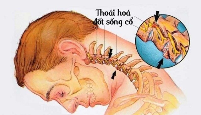 Điều trị thoái hóa đốt sống cổ